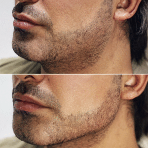 PERFILADO MANDIBULAR