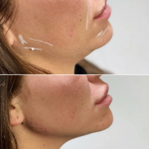 PERFILADO MANDIBULAR