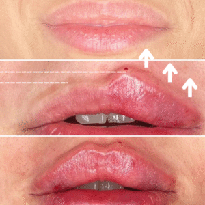 PERFILADO Y AUMENTO DE VOLUMEN DE LABIOS