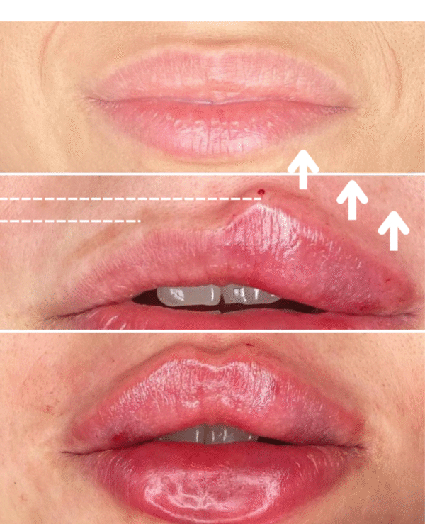 PERFILADO Y AUMENTO DE VOLUMEN DE LABIOS